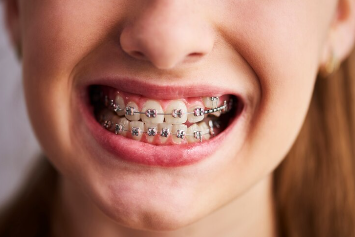 Free Photo Free photo shot of teeth with braces